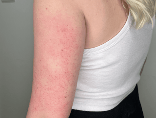 keratosis pilaris treatment (chicken skin treatment)