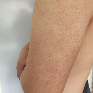 keratosis pilaris rough skin with red dots on upper arm