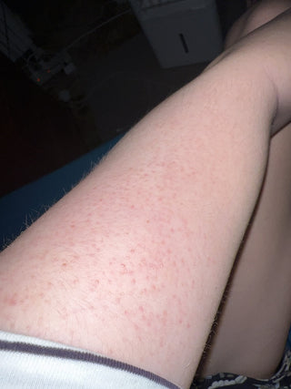 Legs with red bumps from KP
