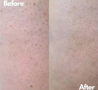 Keratosis Pilaris on calves before and after using BeyondKP cream