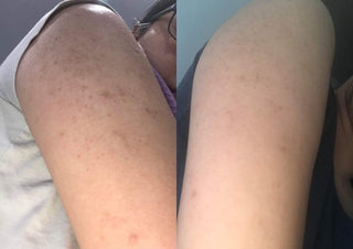 Keratosis Pilaris on arms before and after using BeyondKP cream
