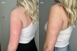 Keratosis Pilaris before after photo