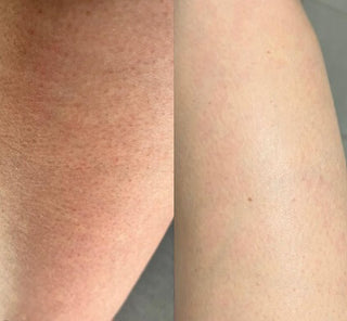 Keratosis Pilaris on legs before and after using BeyondKP cream