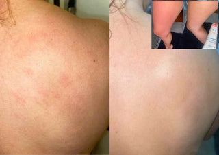 KP irritated skin - 3 minutes after using BeyondKP cream