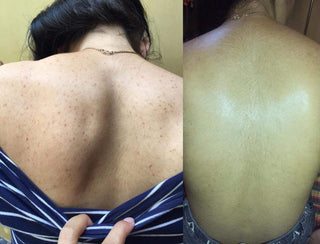 Keratosis Pilaris on back before and after using BeyondKP cream