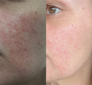 KPRF on face before and after using BeyondKP cream