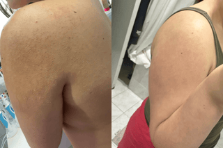 Keratosis pilaris treatment before after using beyondkp