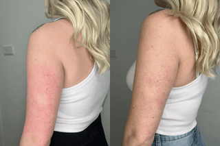 keratosis pilaris treatment female arms