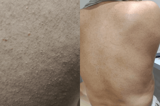 back pimples from keratosis pilaris