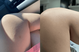 Keratosis pilaris ingrown hair after shaving