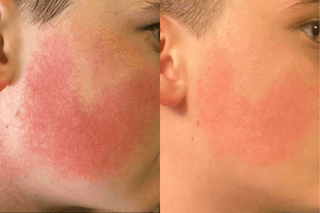 Kprf on face before after treatment with beyondkp